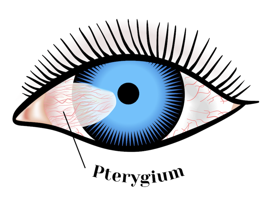 Pterygium surgery