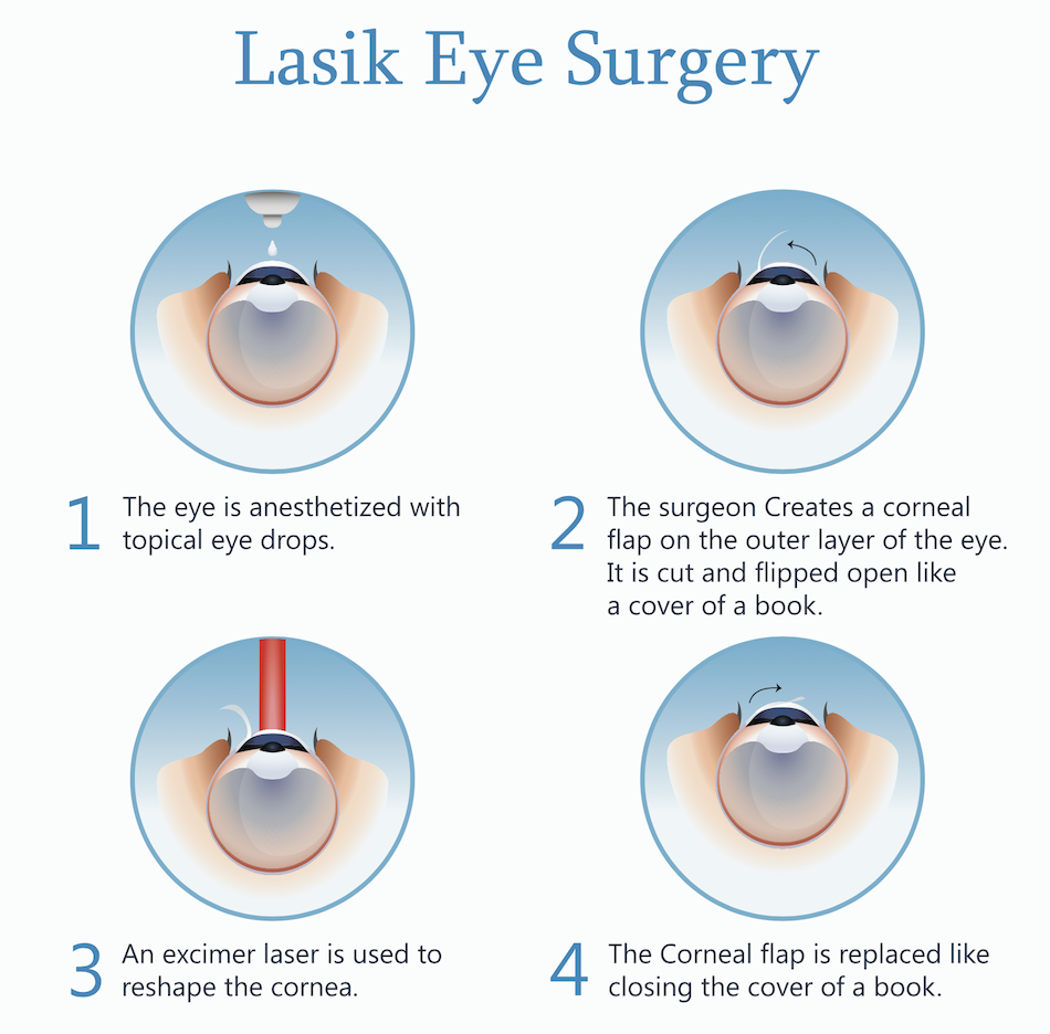 Chirurgie des yeux au laser (LASIK)