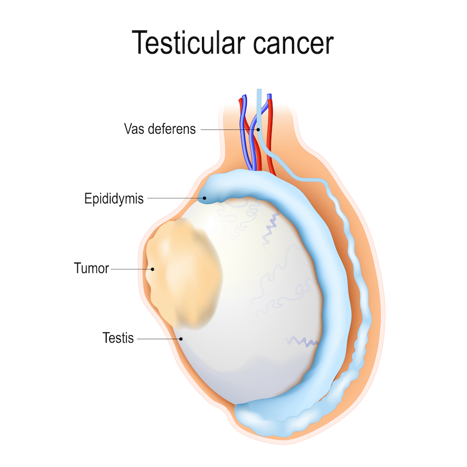 Testicular cancer 