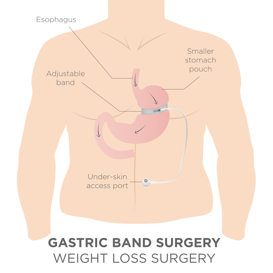 Plastic surgery after weight loss : what you need to know