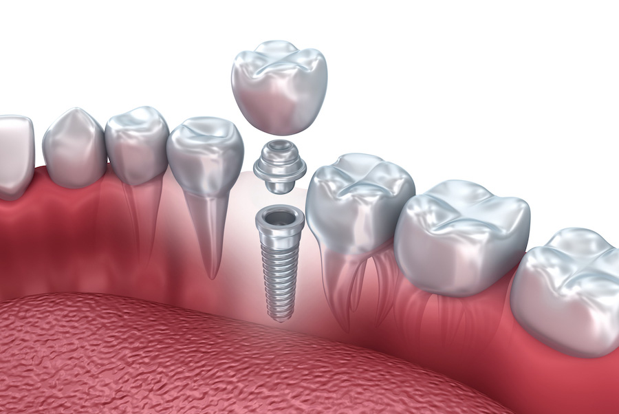 Dental implant