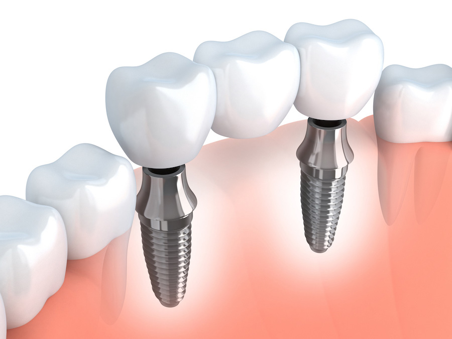 Mini-implant and skeletal anchor