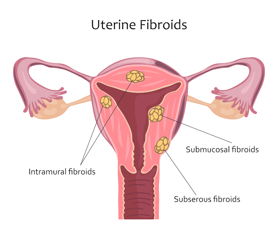 Uterine fibroma