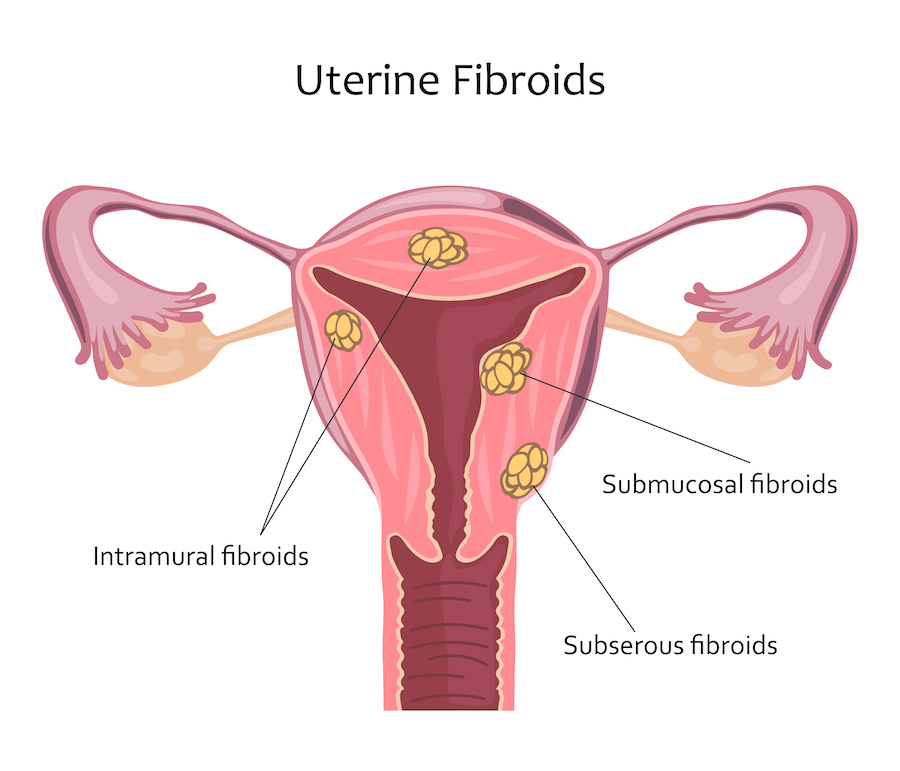 Fibroma